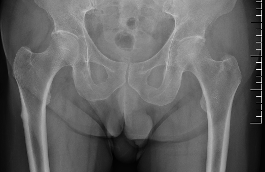 Atypical femur fracture